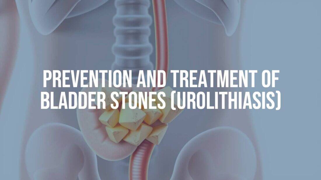 Medical illustration of bladder stones in human urinary system, detailed anatomy, educational, clean and professional style.