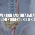 Medical illustration of bladder stones in human urinary system, detailed anatomy, educational, clean and professional style.
